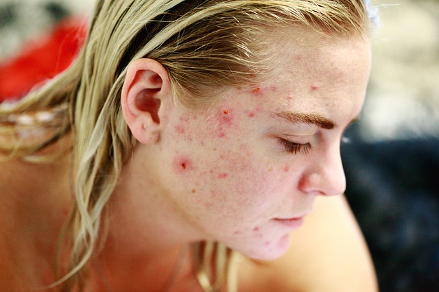 acne cure