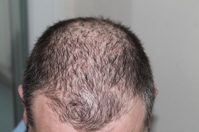 how to stop hair loss for men